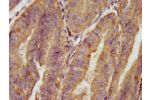 IHC image of CSB-PA001023LA01HU diluted at 1:100 and staining in paraffin-embedded human endometrial cancer performed on a Leica BondTM system. After dewaxing and hydration, antigen retrieval was mediated by high pressure in a citrate buffer (pH 6.0). Sec