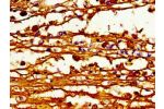Immunohistochemistry of paraffin-embedded human melanoma cancer using CSB-PA001050LA01HU at dilution of 1:100