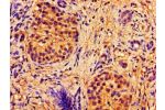 Immunohistochemistry of paraffin-embedded human pancreatic cancer using CSB-PA001053LA01HU at dilution of 1:100