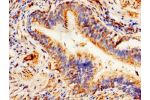 Immunohistochemistry of paraffin-embedded human lung cancer using CSB-PA001068LA01HU at dilution of 1:100