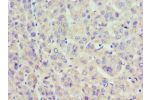 Immunohistochemistry of paraffin-embedded human liver cancer using CSB-PA001117ESR2HU at dilution 1:100