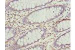 Immunohistochemistry of paraffin-embedded human colon cancer using CSB-PA001126LA01HU at dilution of 1:100