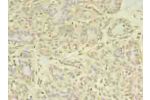 Immunohistochemistry of paraffin-embedded human breast cancer using CSB-PA001158LA01HU at dilution of 1:100
