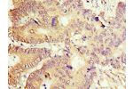 Immunohistochemistry of paraffin-embedded human colon cancer using CSB-PA001169ESR2HU at dilution 1:100