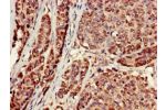 Immunohistochemistry of paraffin-embedded human ovarian cancer using CSB-PA001246EA01HU at dilution of 1:100