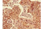 Immunohistochemistry of paraffin-embedded human cervical cancer using CSB-PA001266LA01HU at dilution of 1:100