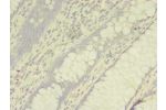 Immunohistochemistry of paraffin-embedded human colon cancer using CSB-PA001273LA01HU at dilution of 1:100
