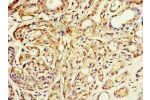 Immunohistochemistry of paraffin-embedded human breast cancer using CSB-PA001355ESR1HU at dilution 1:100