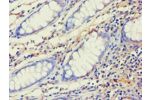 Immunohistochemistry of paraffin-embedded human colon cancer using CSB-PA001405ESR2HU at dilution 1:100