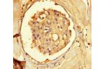 Immunohistochemistry of paraffin-embedded human breast cancer using CSB-PA001474HA01HU at dilution of 1:100