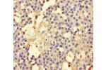 Immunohistochemistry of paraffin-embedded human breast cancer using CSB-PA001474LA01HU at dilution of 1:100