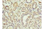Immunohistochemistry of paraffin-embedded human breast cancer using CSB-PA001519ESR2HU at dilution 1:100