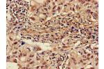 Immunohistochemistry of paraffin-embedded human lung cancer using CSB-PA001559LA01HU at dilution of 1:100