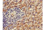 Immunohistochemistry of paraffin-embedded human liver cancer using CSB-PA001582LA01HU at dilution of 1:100