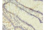 Immunohistochemistry of paraffin-embedded human colon cancer using CSB-PA001624LA01HU at dilution of 1:100