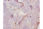 Immunohistochemistry of paraffin-embedded human colon cancer using CSB-PA001666YA01MO at dilution 1:10