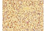 Immunohistochemistry of paraffin-embedded human gastric cancer tissue using CSB-PA001825LA01HU at dilution of 1:100