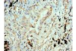Immunohistochemistry of paraffin-embedded human lung cancer using CSB-PA001832ESR1HU at dilution 1:100