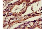 Immunohistochemistry of paraffin-embedded human gastric cancer using CSB-PA001837LA01HU at dilution of 1:100