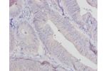 Immunohistochemistry of paraffin-embedded human colon cancer using CSB-PA001858HA01HU at dilution 1:20
