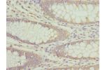 Immunohistochemistry of paraffin-embedded human colon cancer using CSB-PA001874ESR1HU at dilution 1:100