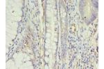 Immunohistochemistry of paraffin-embedded human colon cancer tissue using CSB-PA001910EA01HU at dilution 1:100