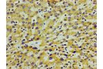 Immunohistochemistry of paraffin-embedded human liver cancer using CSB-PA001917LA01HU at dilution of 1:100