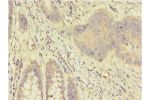 Immunohistochemistry of paraffin-embedded human colon cancer using CSB-PA001935EA01HU at dilution 1:100