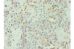 Immunohistochemistry of paraffin-embedded human breast cancer using CSB-PA001940ESR1HU at dilution 1:100
