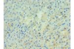 Immunohistochemistry of paraffin-embedded human liver cancer using CSB-PA001954DSR2HU at dilution 1:100