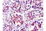 Immunohistochemistry of paraffin-embedded human gastric cancer using CSB-PA001955LA01HU at dilution of 1:100