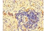 Immunohistochemistry of paraffin-embedded human lung cancer using CSB-PA002012LA01HU at dilution of 1:100