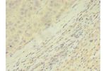 Immunohistochemistry of paraffin-embedded human liver cancer using CSB-PA002026LA01HU at dilution of 1:100