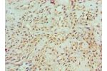 Immunohistochemistry of paraffin-embedded human breast cancer using CSB-PA002198ESR1HU at dilution 1:100