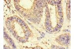 Immunohistochemistry of paraffin-embedded CSB-PA002212LA01HU using human endometrial cancer at dilution 1:100
