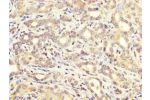 IHC image of CSB-PA002268LA01HU diluted at 1:200 and staining in paraffin-embedded human liver cancer performed on a Leica BondTM system. After dewaxing and hydration, antigen retrieval was mediated by high pressure in a citrate buffer (pH 6.0). Section w