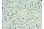 Immunohistochemistry of paraffin-embedded human lung cancer tissue using CSB-PA002279ESR2HU at dilution 1:100