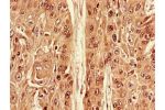 Immunohistochemistry of paraffin-embedded human cervical cancer using CSB-PA002294LA01HU at dilution of 1:100
