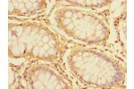 Immunohistochemistry of paraffin-embedded human colon cancer using CSB-PA002328LA01HU at dilution of 1:100