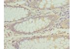 Immunohistochemistry of paraffin-embedded human colon cancer using CSB-PA002336DSR1HU at dilution 1:100