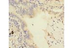 Immunohistochemistry of paraffin-embedded human lung cancer using CSB-PA002355HA01HU at dilution 1:100