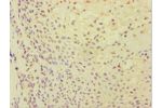 Immunohistochemistry of paraffin-embedded human breast cancer using CSB-PA002369ESR2HU at dilution 1:100