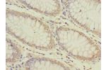 Immunohistochemistry of paraffin-embedded human colon cancer CSB-PA002390ESR1HU at dilution 1:100