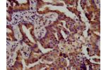 IHC image of CSB-PA002424LA01HU diluted at 1:400 and staining in paraffin-embedded human lung cancer performed on a Leica BondTM system. After dewaxing and hydration, antigen retrieval was mediated by high pressure in a citrate buffer (pH 6.0). Section wa