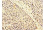 Immunohistochemistry of paraffin-embedded human ovarian cancer CSB-PA002435ESR1HU at dilution 1:100