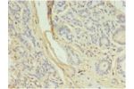 Immunohistochemistry of paraffin-embedded human breast cancer using CSB-PA002458EA01HU at dilution 1:100