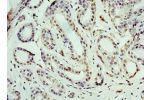 Immunohistochemistry of paraffin-embedded human breast cancer using CSB-PA002597ESR2HU at dilution 1:100