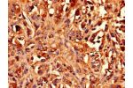 Immunocytochemistry analysis of human melanoma cancer using CSB-PA002600EA01HU at dilution of 1:100