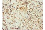 Immunohistochemistry of paraffin-embedded human breast cancer using CSB-PA002607ESR1HU at dilution 1:100