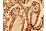 Immunocytochemistry analysis of human pancreatic cancer using CSB-PA002683EA01HU at dilution of 1:100
